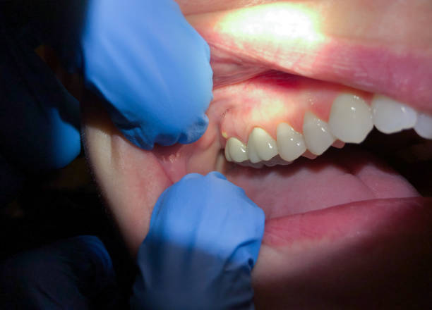 Best Emergency Dental Care for Broken or Chipped Teeth in Killeen, TX