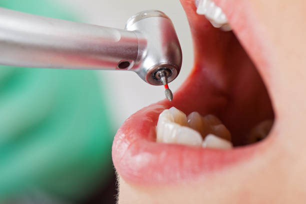 Best Emergency Wisdom Teeth Removal in Killeen, TX